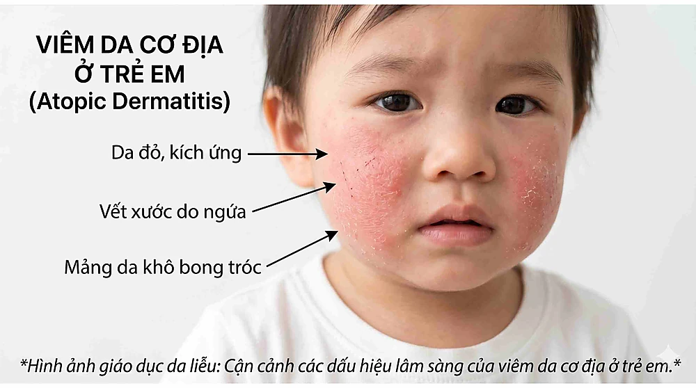 Dấu hiệu viêm da cơ địa trẻ: da đỏ, ngứa, nứt nẻ ở mặt