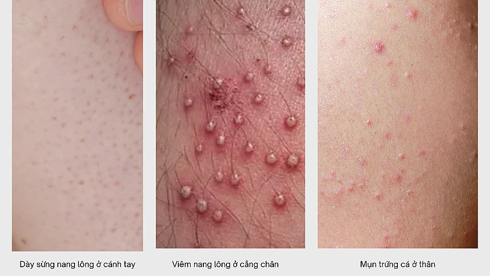 Phân biệt: dày sừng nang lông, viêm nang lông, mụn trứng cá thân