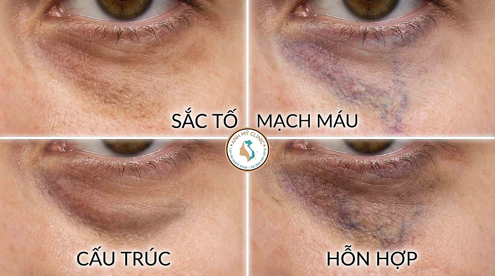 Hình ảnh minh họa y khoa phân biệt 4 loại quầng thâm mắt: sắc tố, mạch máu, cấu trúc và hỗn hợp.