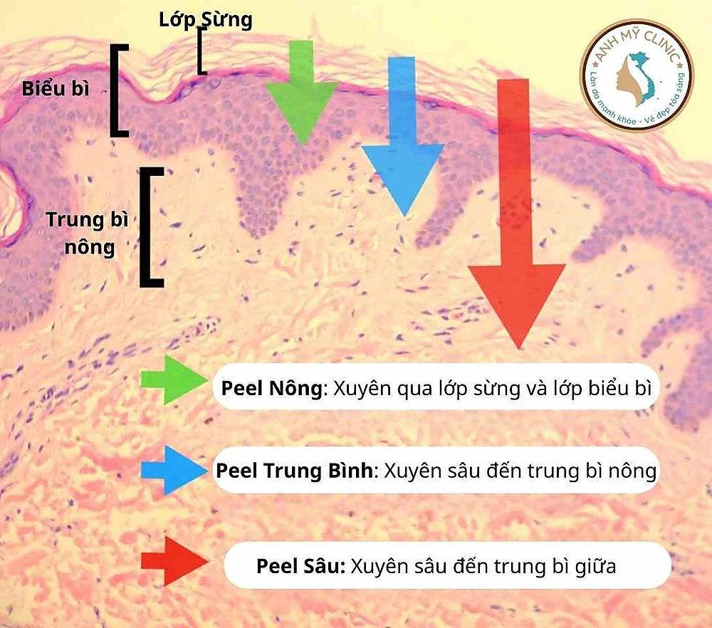 Phân biệt 3 cấp độ peel da hóa học và ứng dụng tương ứng.