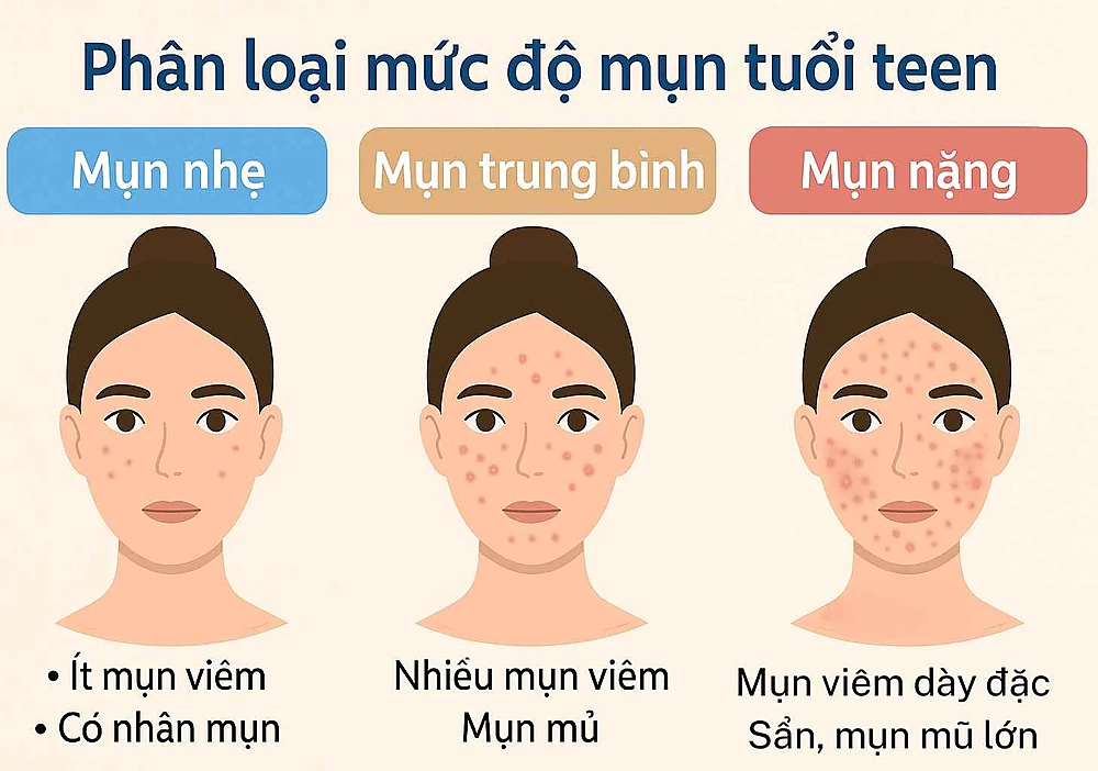 Phân loại mức độ mụn tuổi teen