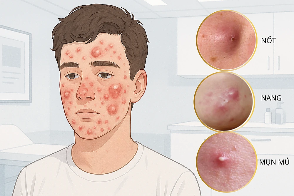 Phân loại mụn trứng cá nặng