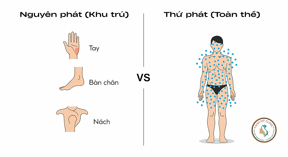 Phân loại tăng tiết mồ hôi