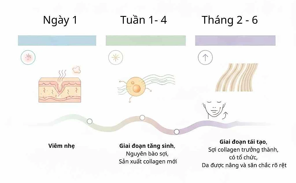 Quá trình tân tạo collagen sau liệu trình HIFU vùng mặt, nọng cằm, mang lại hiệu quả trẻ hóa bền vững sau 2-6 tháng.