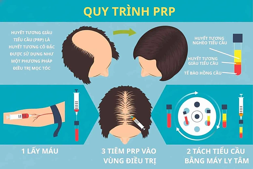 Qui trình PRP