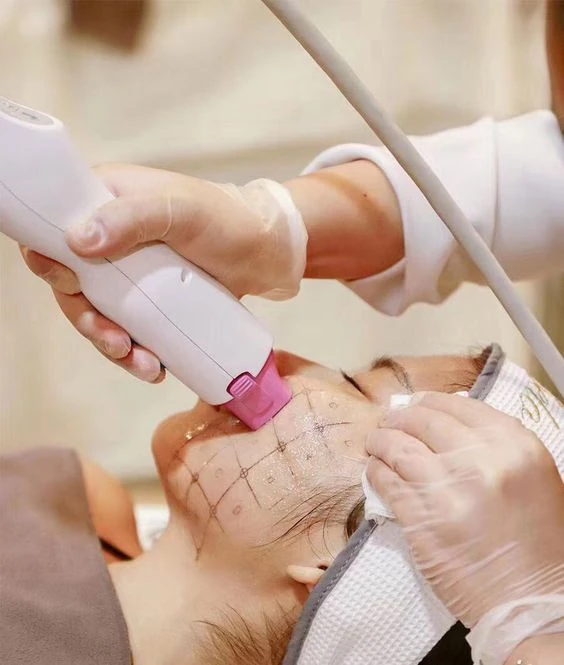 Điều trị trẻ hóa da bằng sóng RF vi kim giúp săn chắc và giảm nếp nhăn tại Anh Mỹ Clinic