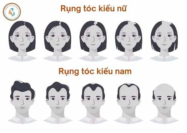 Minh họa sự khác biệt giữa rụng tóc kiểu nữ và rụng tóc kiểu nam.