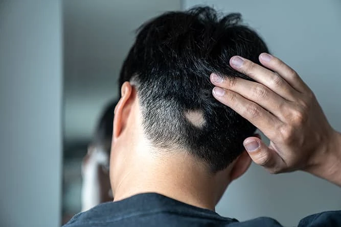 Rụng tóc từng vùng