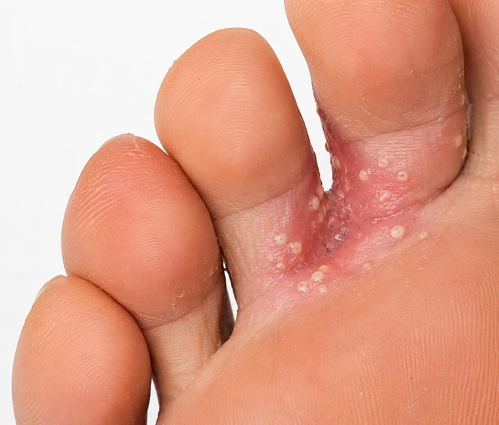 Sẩn mụn mủ vệ tinh – dấu hiệu đặc trưng nhận biết nấm Candida kẽ ngón chân, phân biệt với nấm sợi