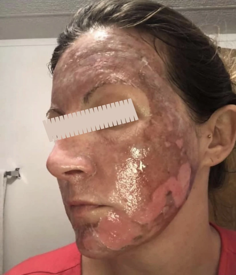 Sẹo bỏng sau peel da hóa chất