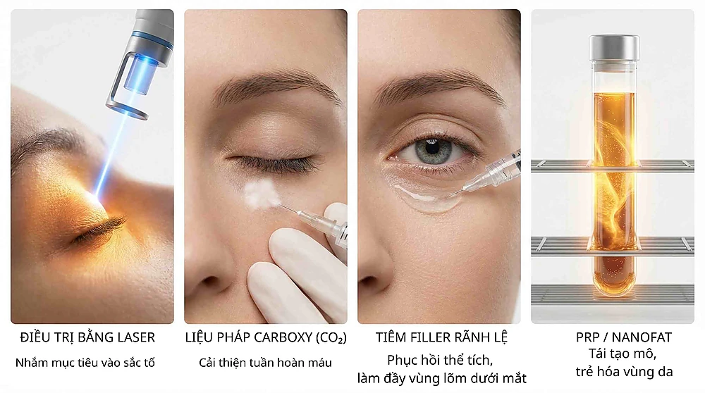 Các phương pháp trị thâm mắt: Laser Picosecond, Carboxytherapy, Filler và Cấy mỡ Nano.