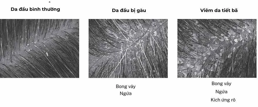 Ba hình ảnh vi mô so sánh da đầu bình thường, da đầu bị gàu và da đầu viêm da tiết bã, thể hiện mức độ bong vảy, ngứa và kích ứng khác nhau.
