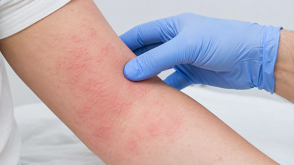 Bác sĩ kiểm tra phản ứng da sau truyền glutathione – dấu hiệu tác dụng phụ cần theo dõi