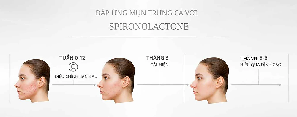 Infographic mô tả timeline hiệu quả spironolactone trong mụn tuổi dậy thì nữ: 8–12 tuần bắt đầu đáp ứng, 5–6 tháng tối đa.