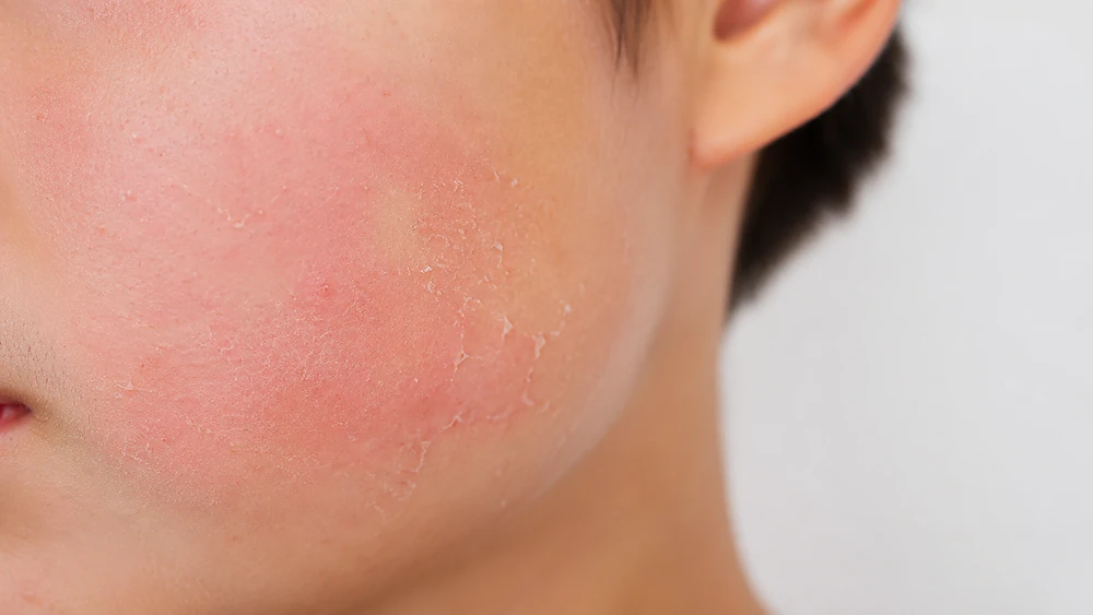  Da thiếu niên bị kích ứng nhẹ do dùng retinol — đỏ da và bong tróc là tác hại thường gặp