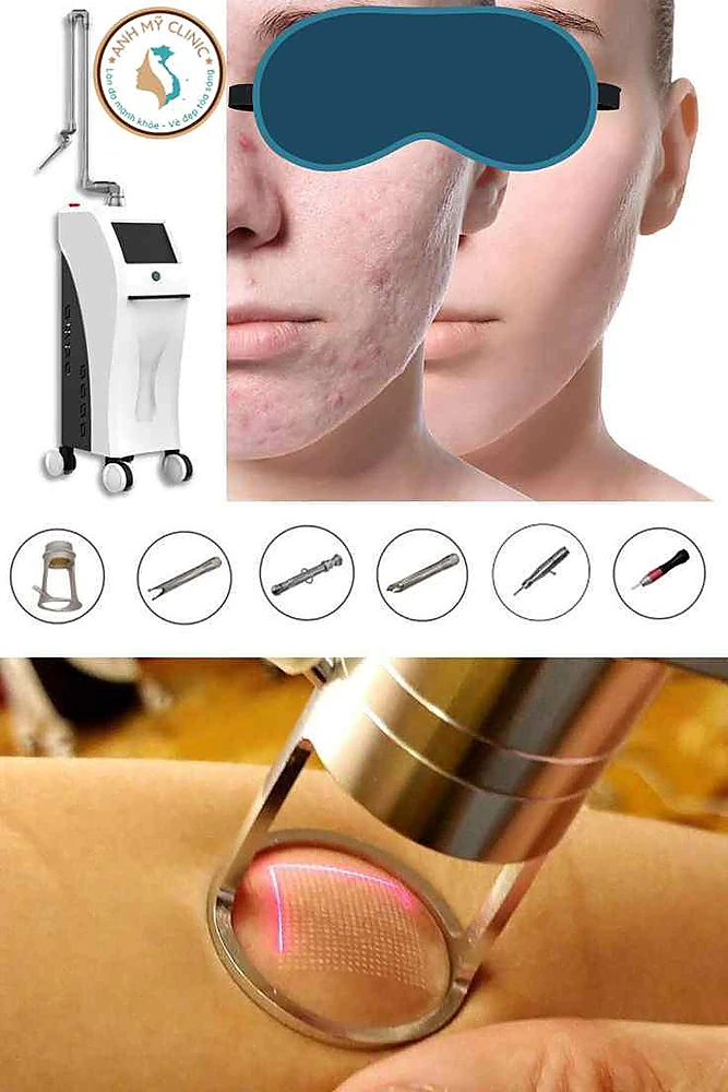 Laser Nd:Yag chữa sẹo mụn