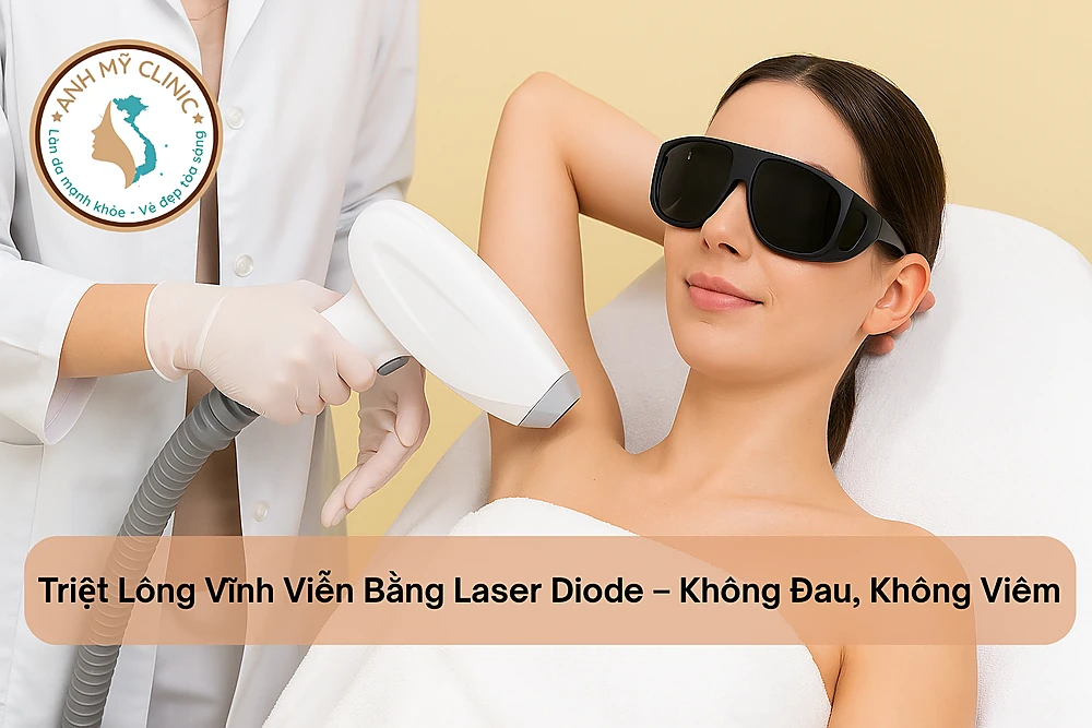 Triệt lông vĩnh viễn bằng laser diode, không đau, không viêm