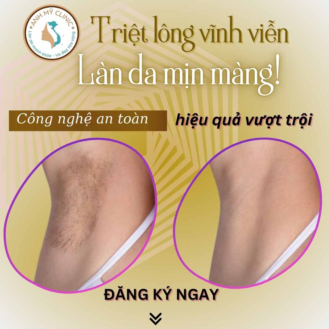 Kết quả triệt lông nách bằng laser diode tại Anh Mỹ Clinic
