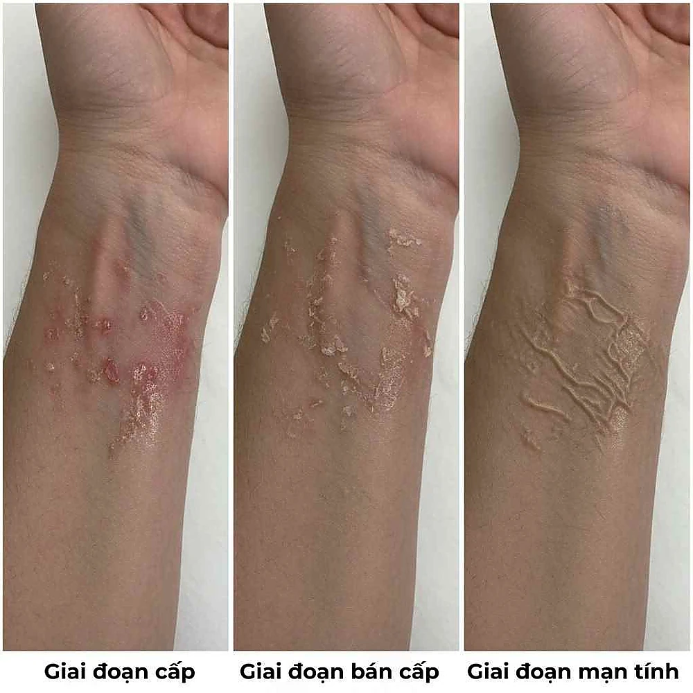 Biểu hiện của viêm da tiếp xúc dị ứng thay đổi qua các giai đoạn từ cấp tính đến mạn tính.