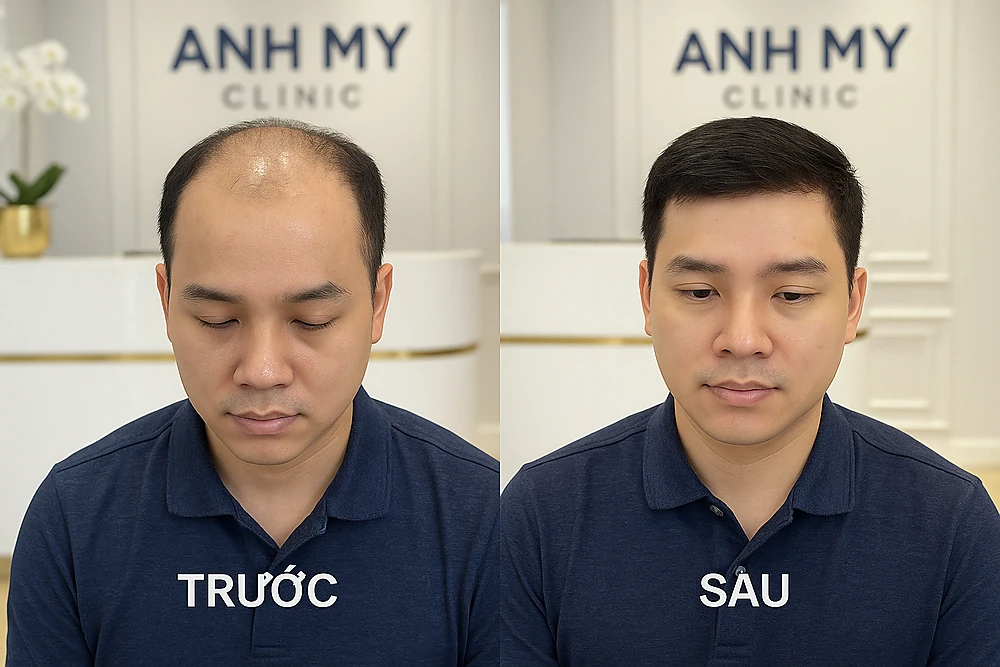 Hình ảnh trước và sau điều trị hói đầu bằng LDOM và PRP tại Anh Mỹ Clinic.
