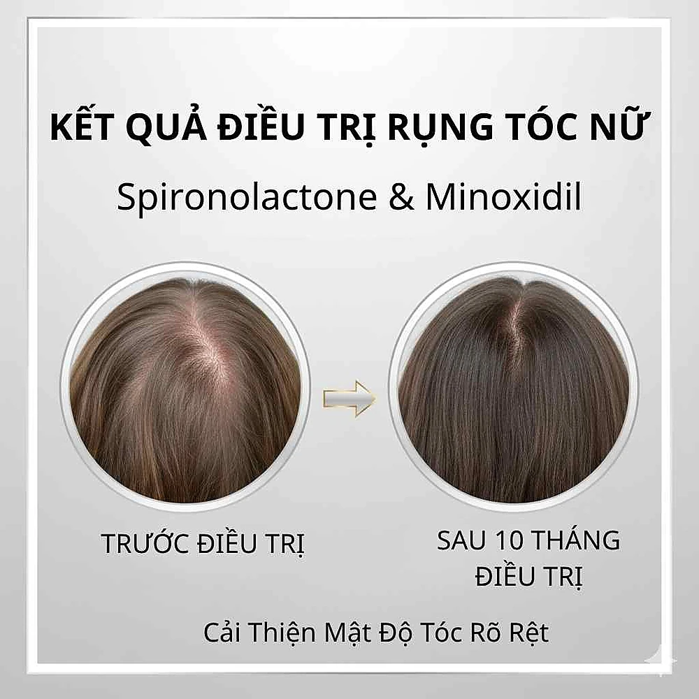 Cải thiện mật độ tóc sau 10 tháng điều trị rụng tóc kiểu nữ bằng spironolactone tại Anh Mỹ Clinic.