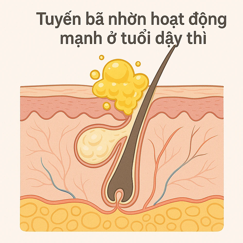 Tuyến bã nhờn hoạt động mạnh ở tuổi dậy thì