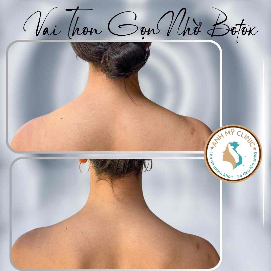 Tiêm botox thon gọn vai — hình trước và sau