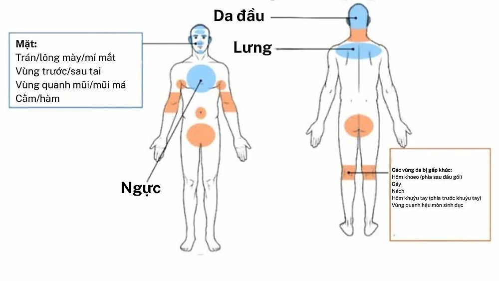 Sơ đồ cơ thể người nhìn từ trước và sau, tô màu vùng thường bị viêm da tiết bã gồm da đầu, mặt, ngực, lưng và các vùng da gấp khúc như gáy, nách, khuỷu tay, khoeo chân, quanh hậu môn – sinh dục.