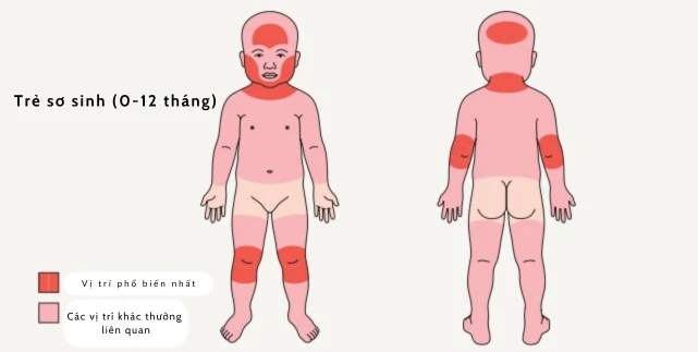 Vị Trí Viêm Da Cơ Địa Ở Trẻ Sơ Sinh