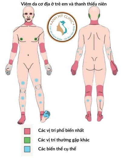 Viêm da cơ địa ở trẻ em và thanh thiếu niên