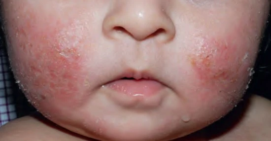 Viêm da cơ địa ở trẻ sơ sinh