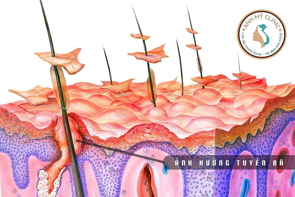 Viêm da dầu ảnh hưởng tuyến bã