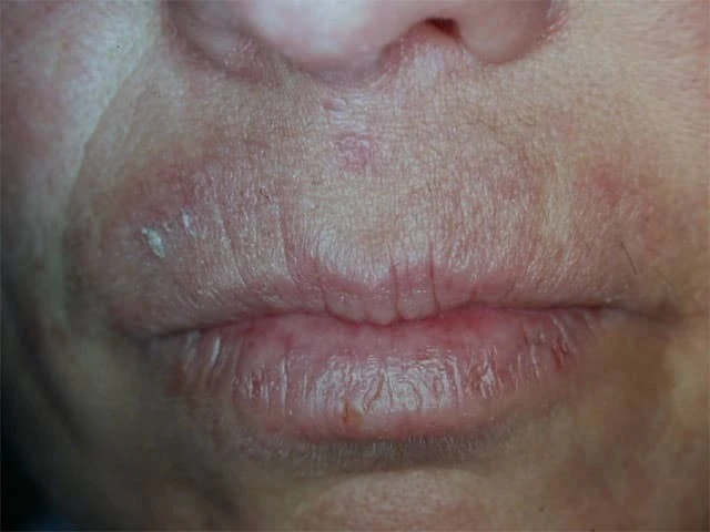 Viêm môi dị ứng tiếp xúc thuốc nhuộm tóc