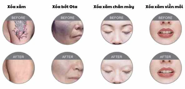 Xóa xăm, bớt Ota, xăm chân mày, xăm môi